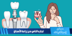 تجارب الناس مع زراعة الأسنان