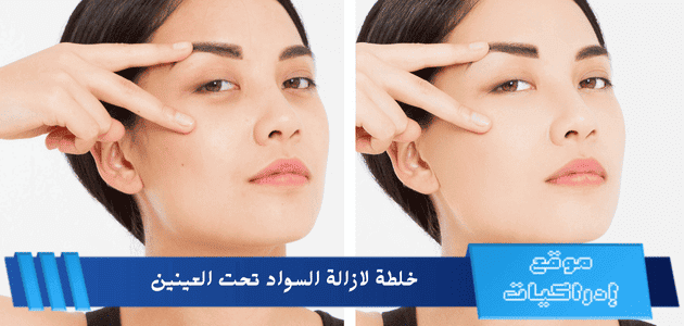 خلطة لازالة السواد تحت العينين